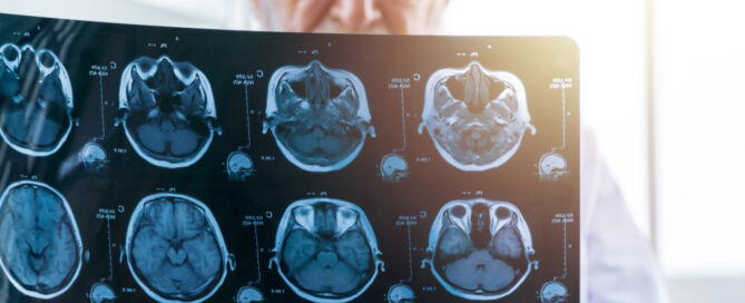 man Looking,At,The,Mri,Film,Of,The,Human,Brain. dementia tsunami; memory care